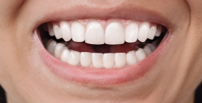 After Aligners Treatment