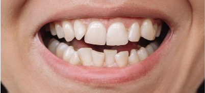 Before Aligners Treatment