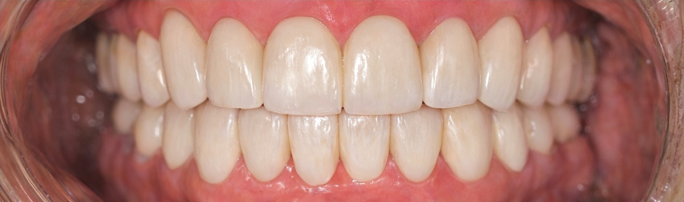 After Smile Makeover