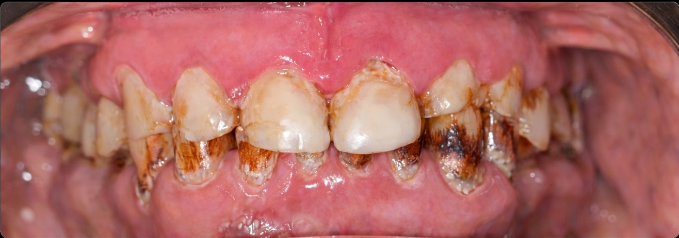 Before Smile Makeover